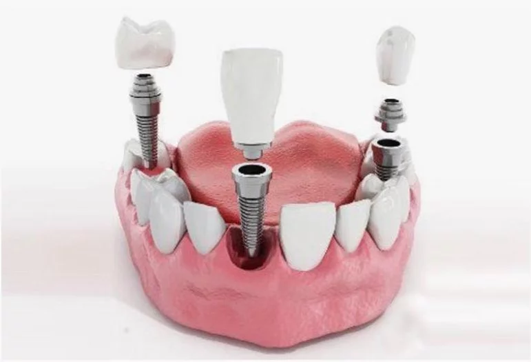 implant3
